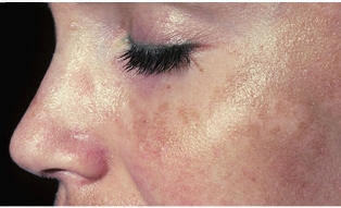 melasma