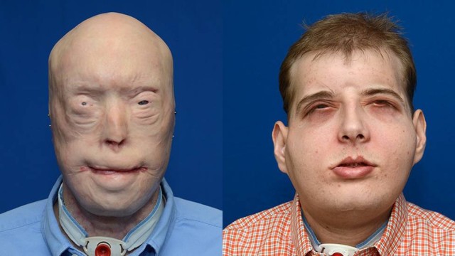 Antes e depois do bombeiro que recebeu um transplante de rosto