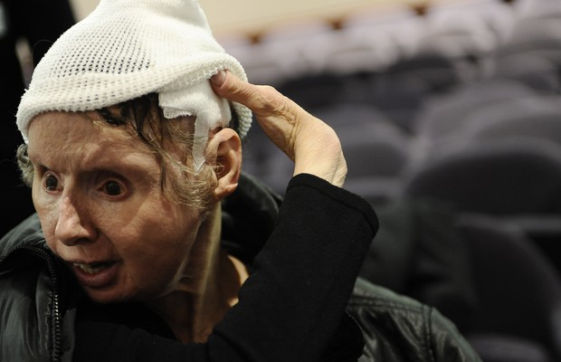 Durante a audiência, ela mostrou seus curativos (Foto: AP Photo/Jessica Hill)