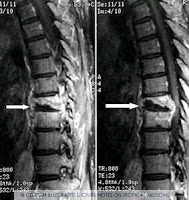 Tuberculose vertebral