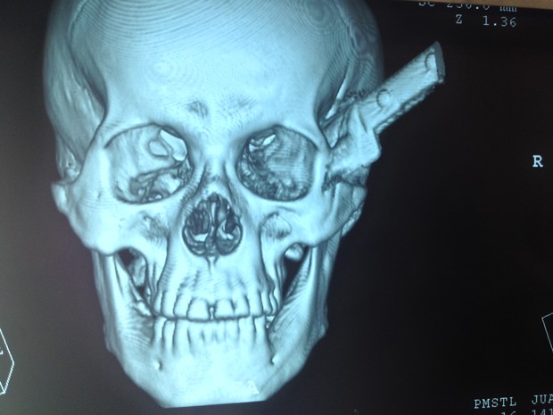 Em tomografria é possível ver a faca cravada no crânio do homem (Foto: Ellyo Teixeira/G1)