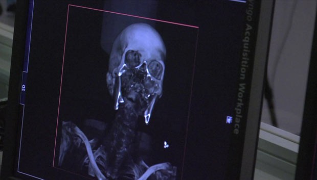 Técnica conhecida como 'virtopsy' faz exames pós-morte com poucas intervenções no corpo para preservar provas essenciais a investigações. (Foto: BBC)