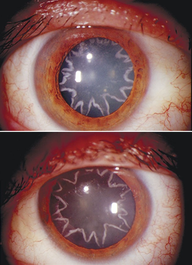 Opacidade no cristalino tem forma de estrela (Foto: Bobby Korn/Don Kikkawa/The New England Journal of Medicine)